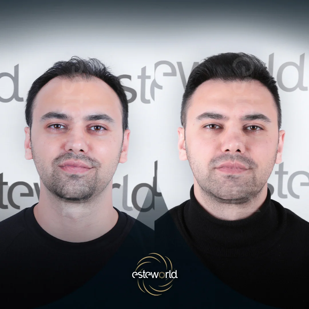 hair-before-after5