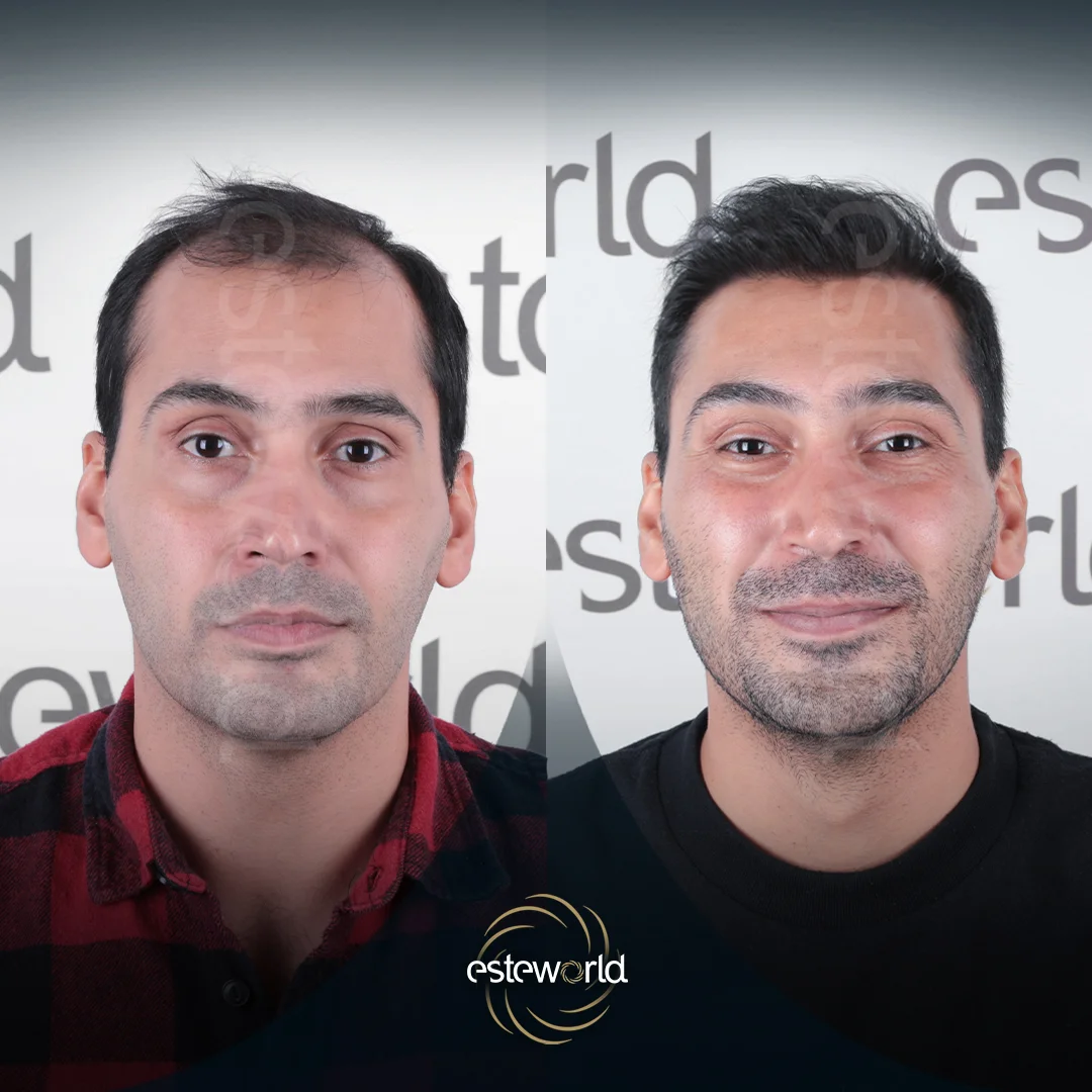 hair-before-after6