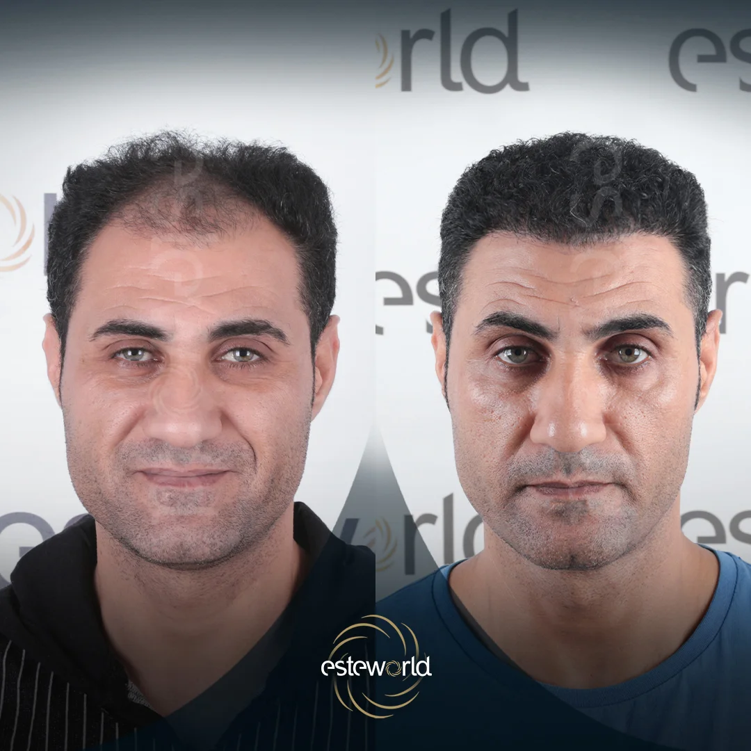 hair-before-after7