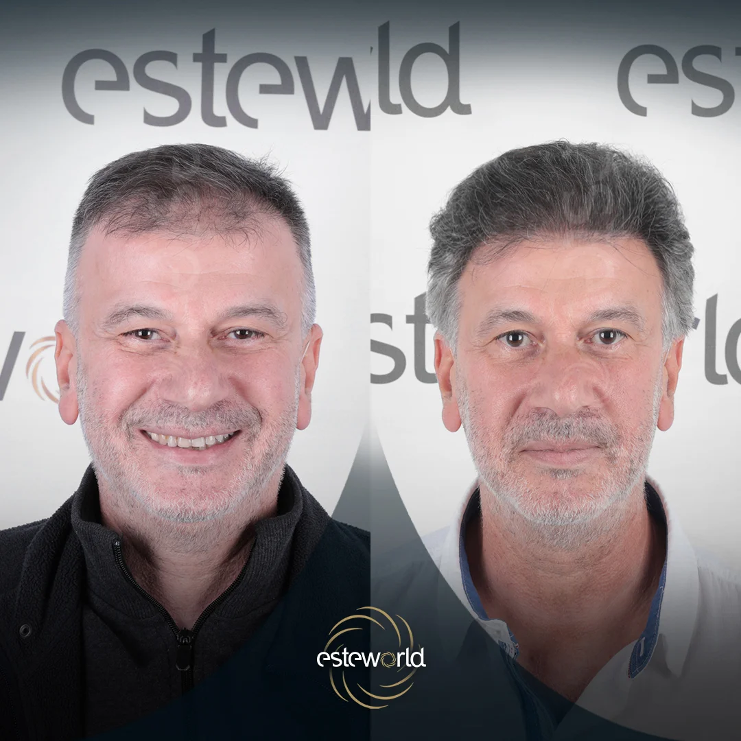 hair-before-after8