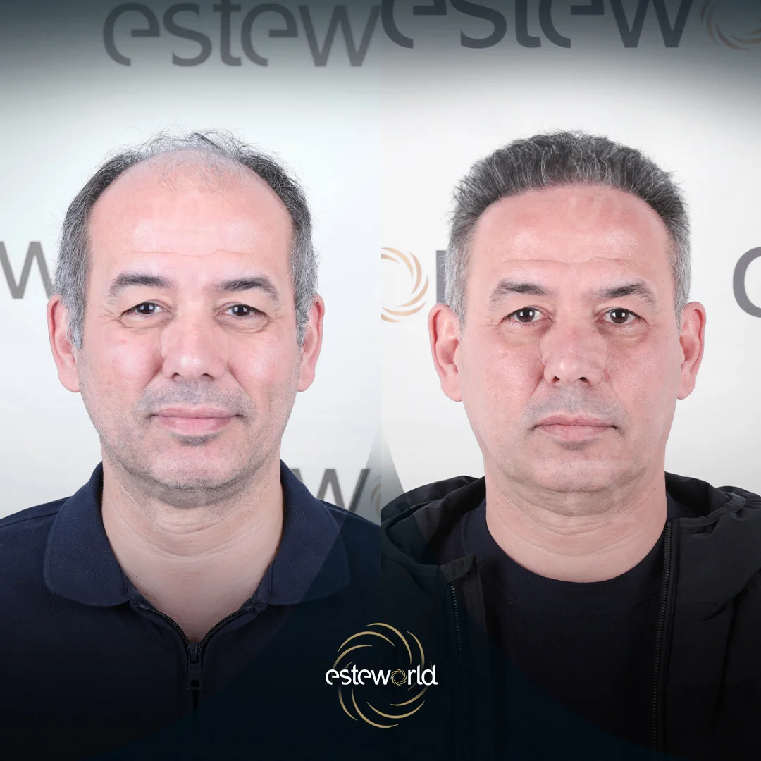 hair-before-after9