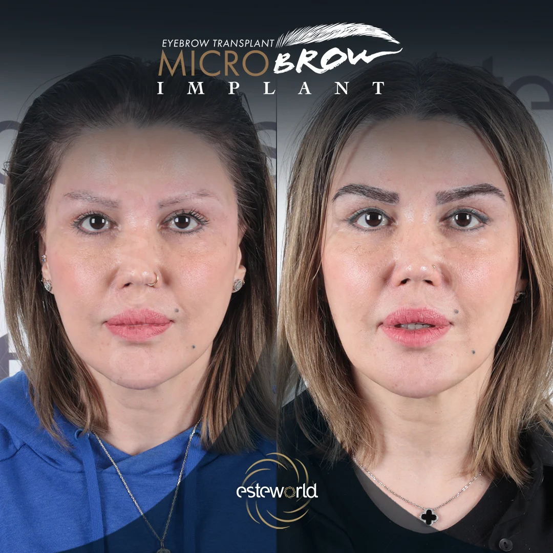 kas-before-after1