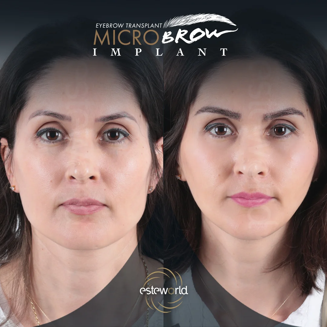 kas-before-after3