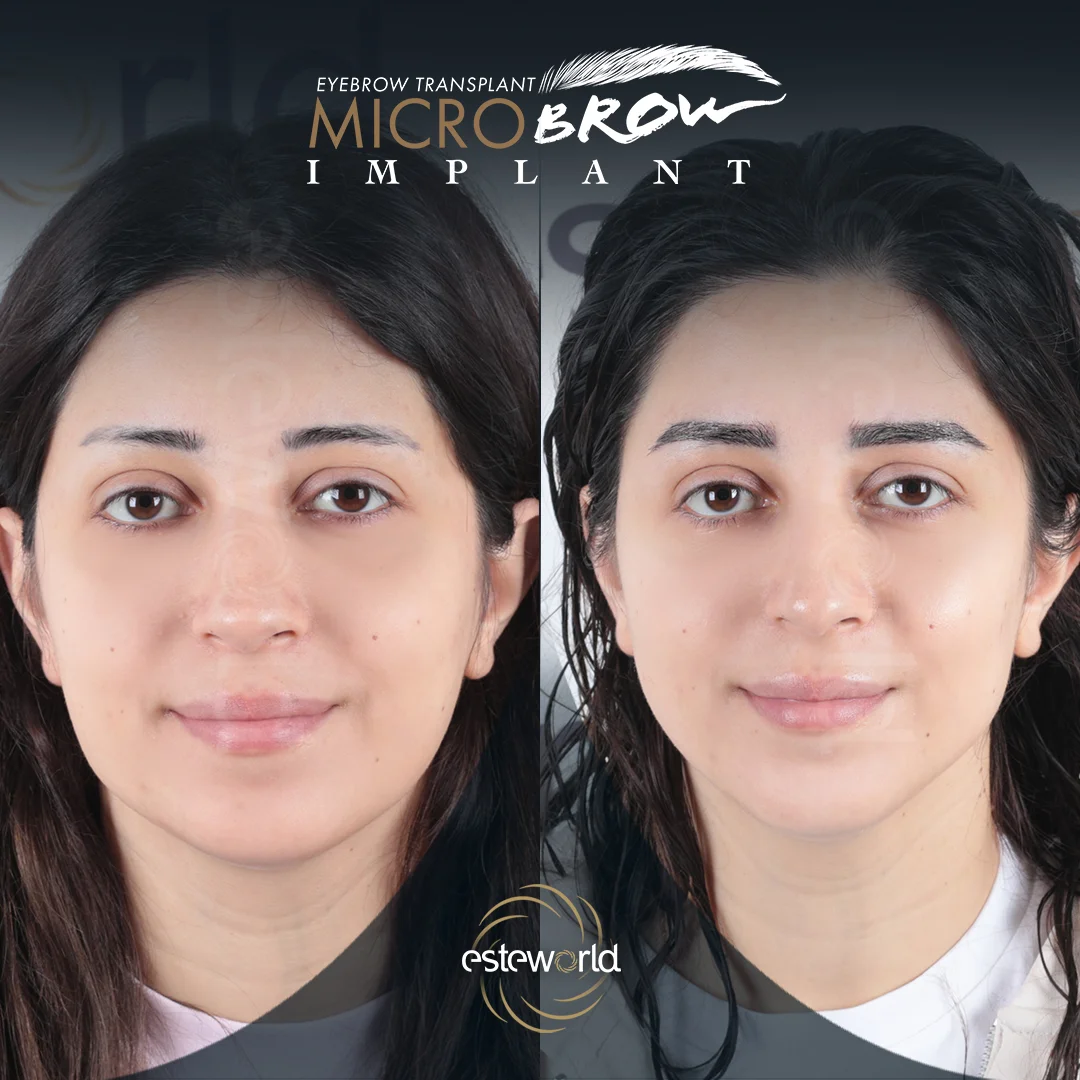 kas-before-after4