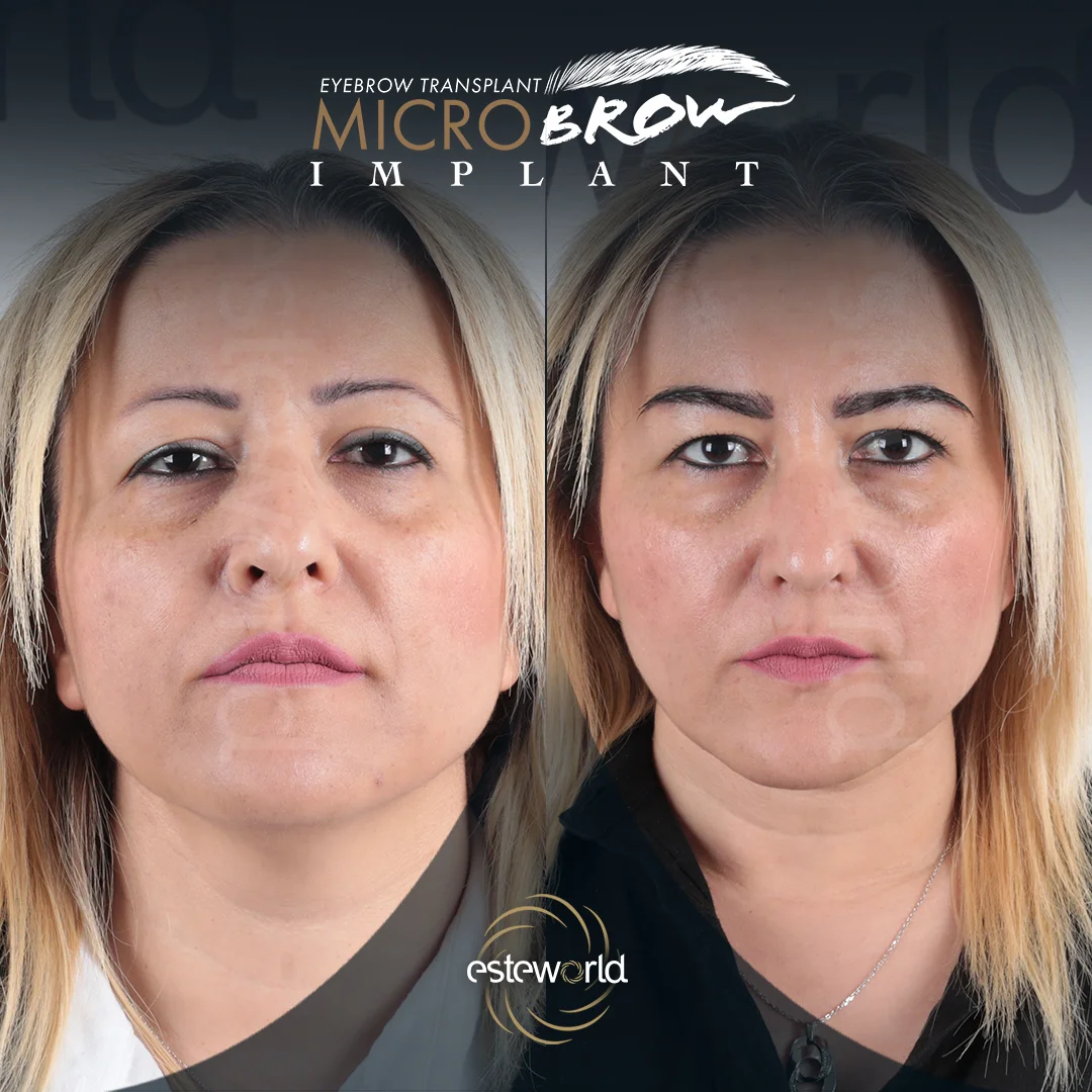 kas-before-after5