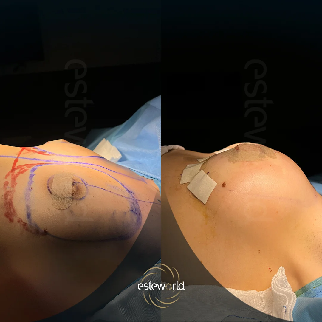 breast-before-after11