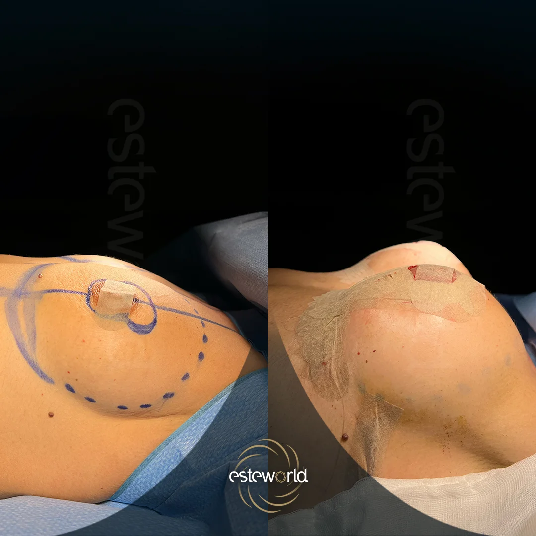 breast-before-after13
