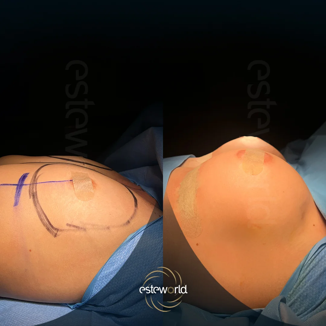 breast-before-after2