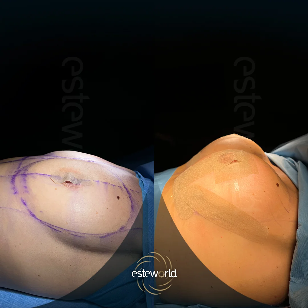 breast-before-after3