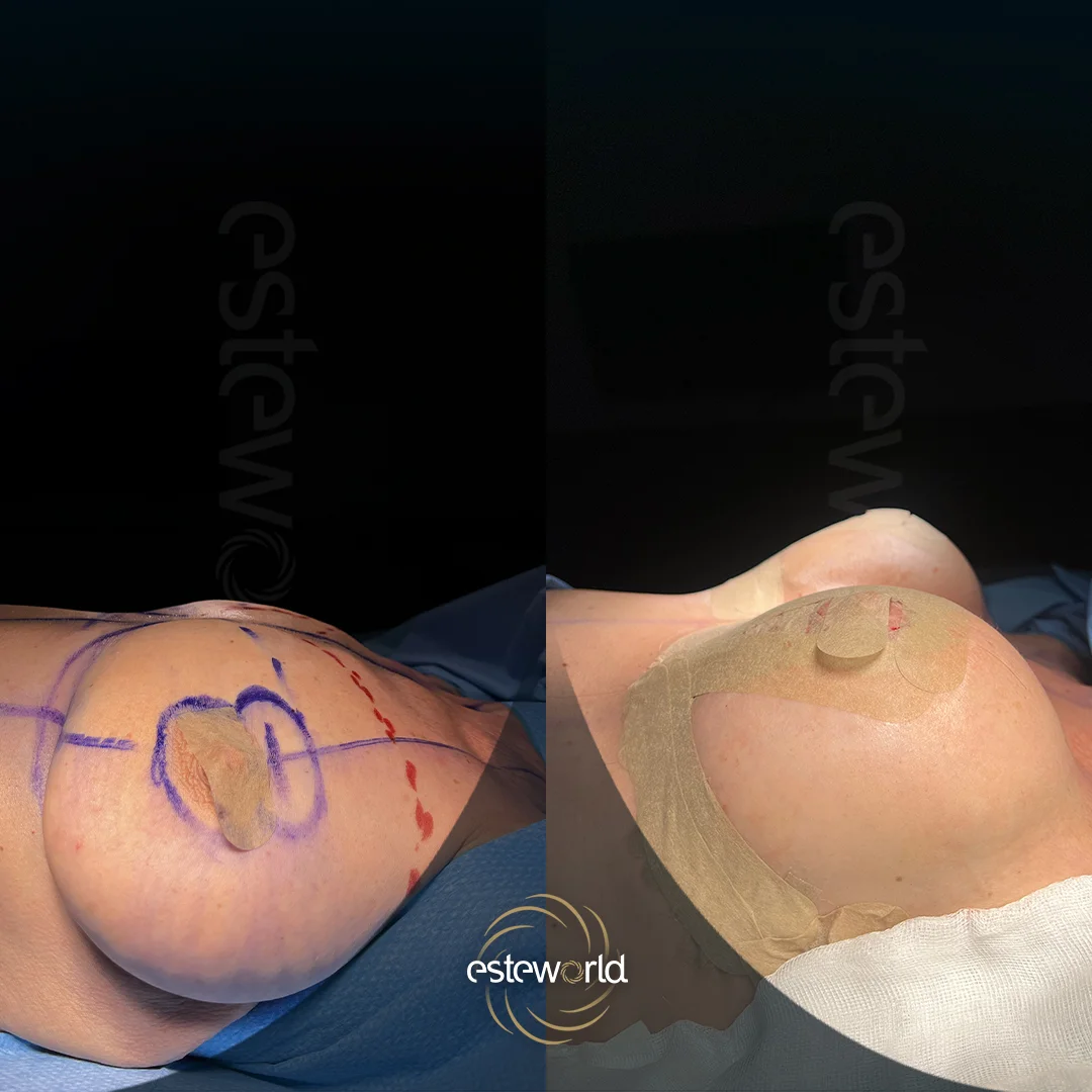 breast-before-after4