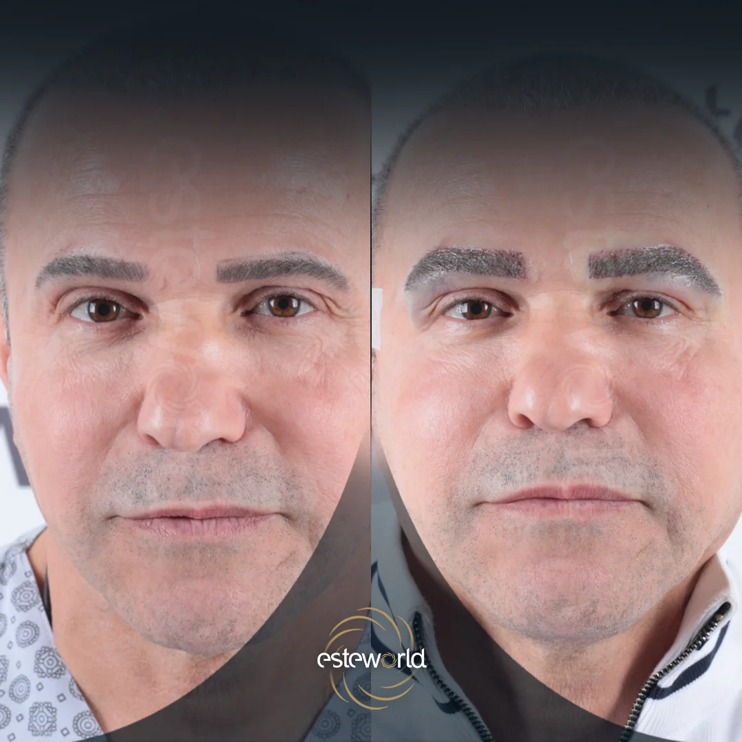 eyebrow-before-after0