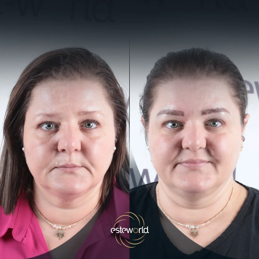 eyebrow-before-after1