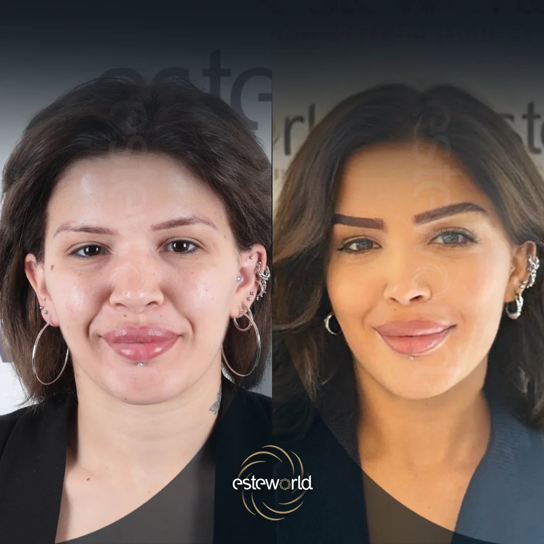 eyebrow-before-after10