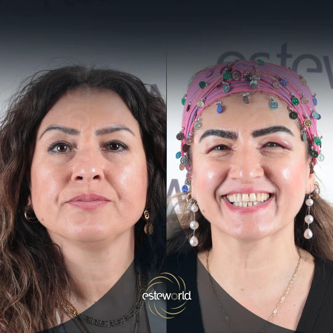 eyebrow-before-after12