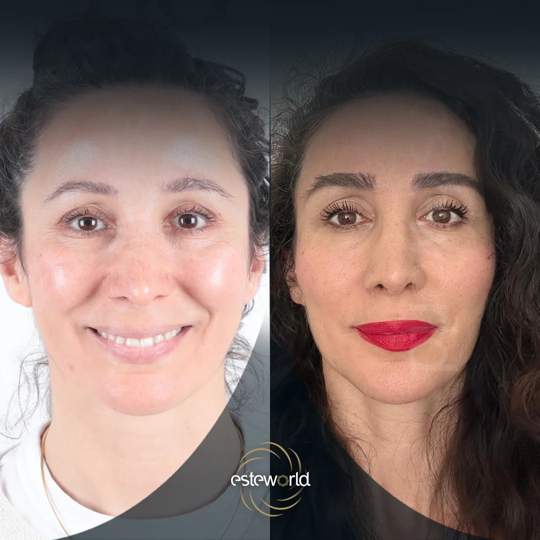 eyebrow-before-after3