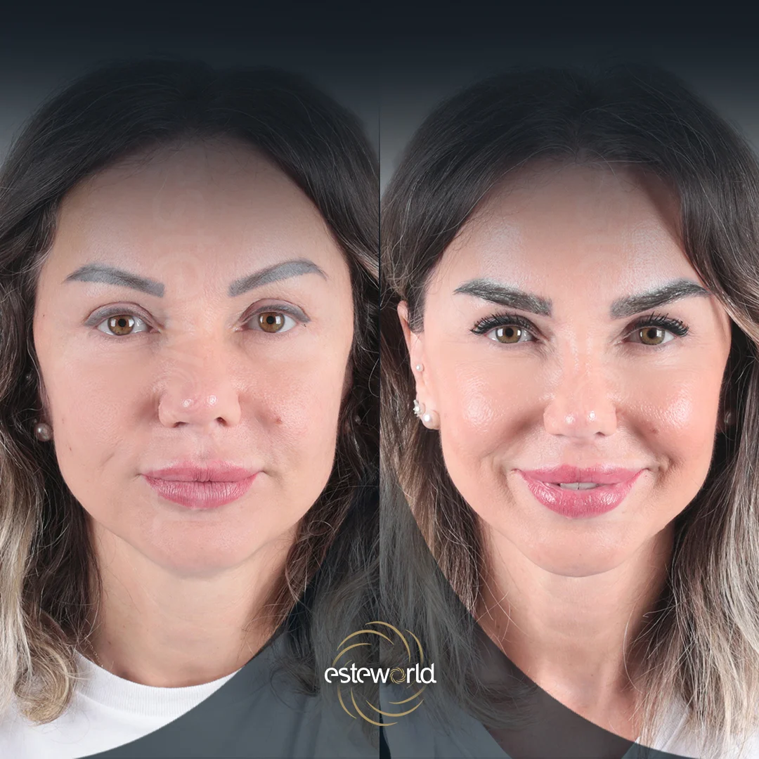 eyebrow-before-after4