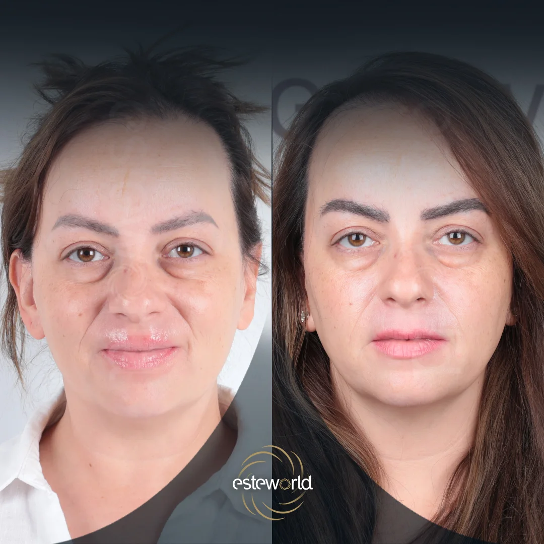 eyebrow-before-after5