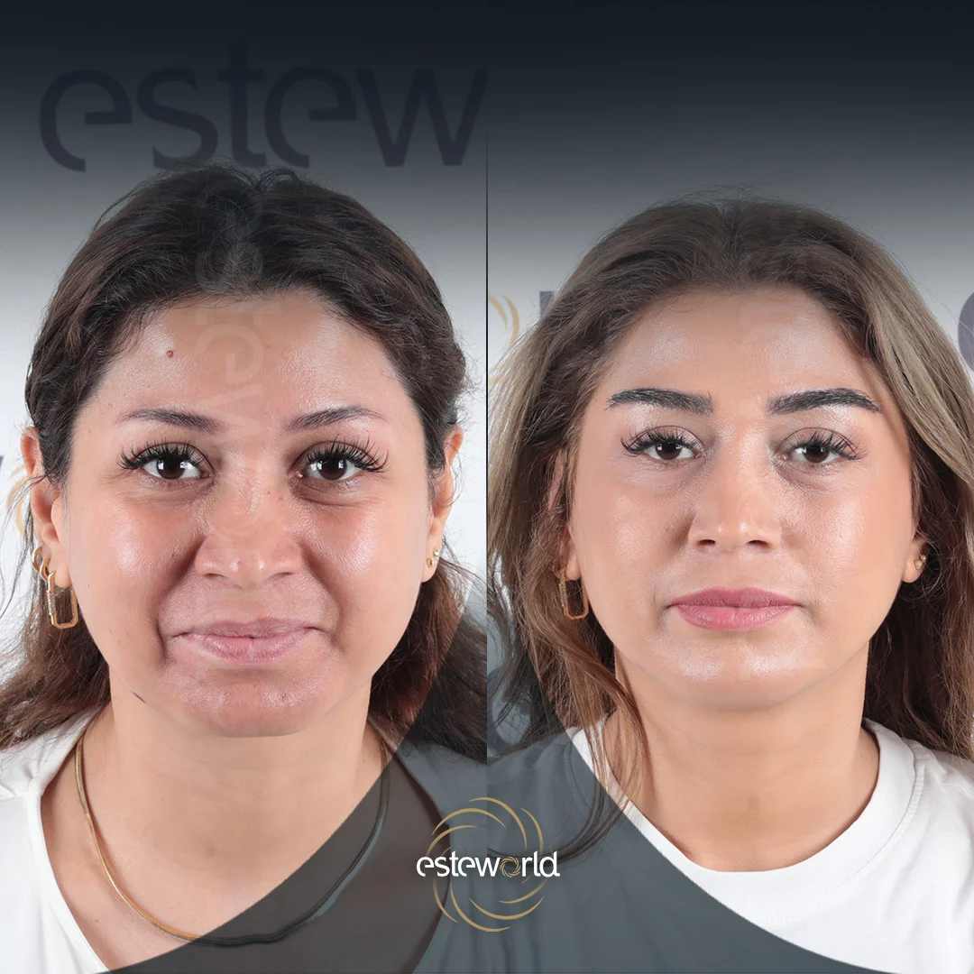 eyebrow-before-after9