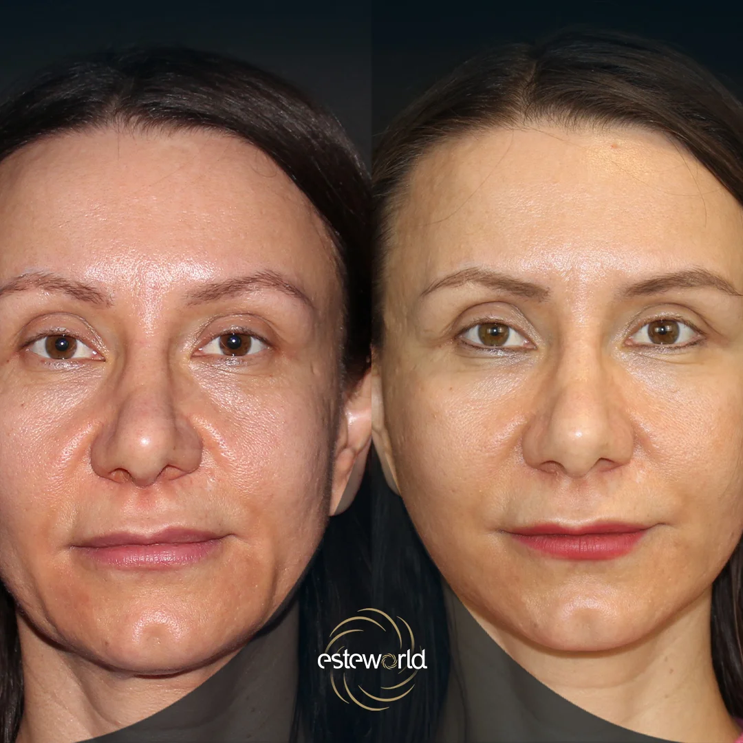 plastik-before-after1