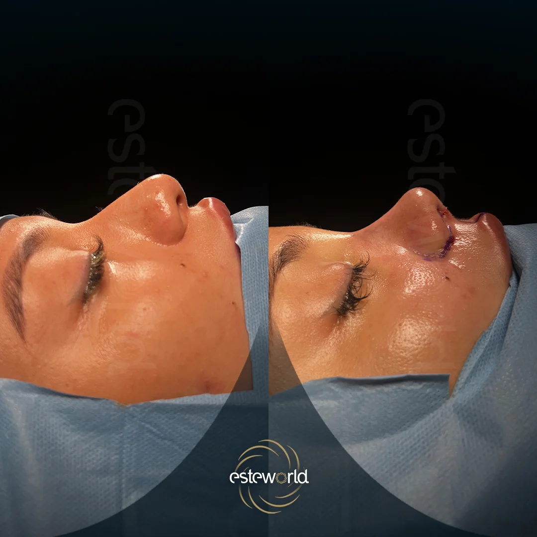 plastik-before-after10