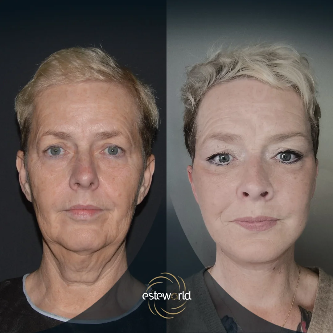 plastik-before-after2