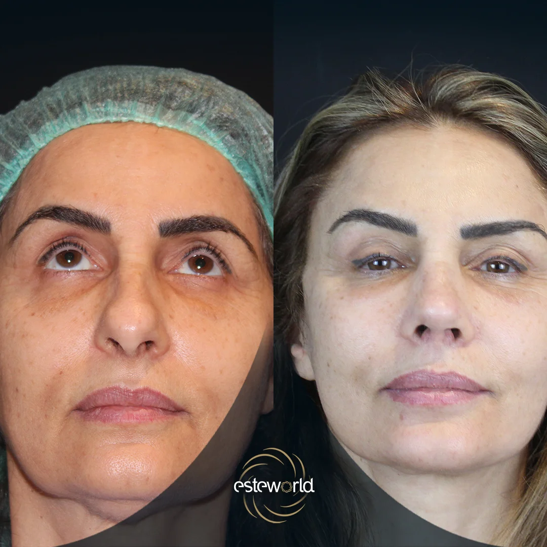 plastik-before-after3