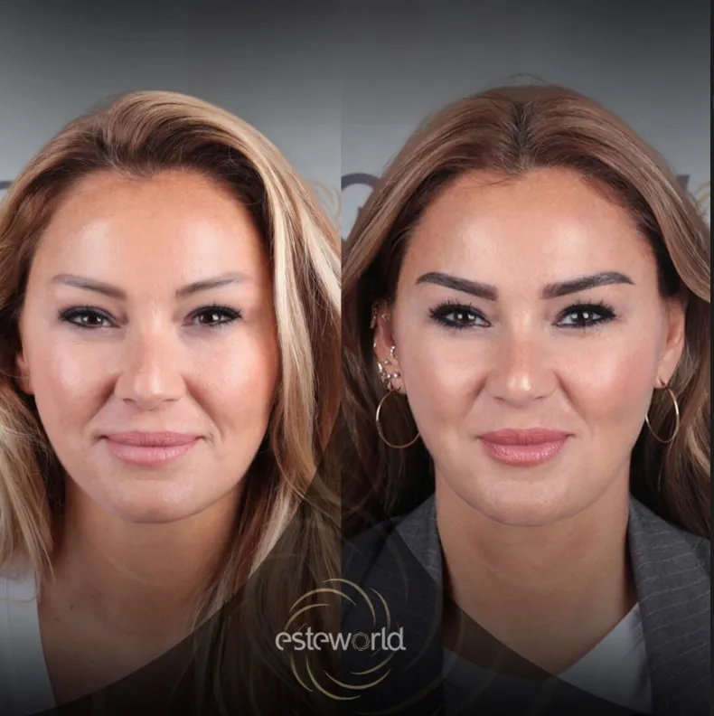 pinar-altug-before-after