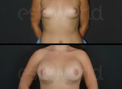 breast-2