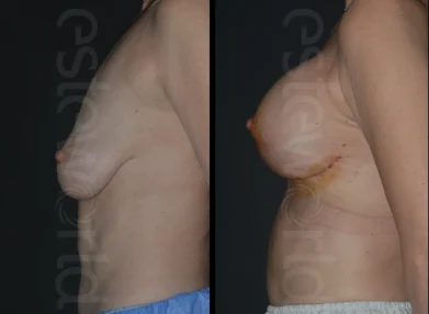 breast-3