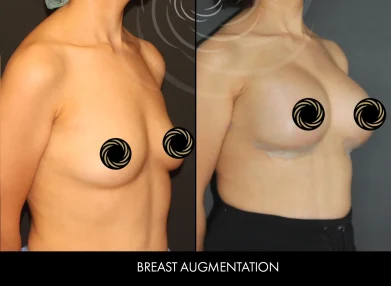 breast-before-after2 (1)