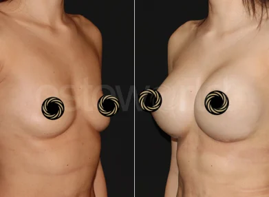 breast-before-after3