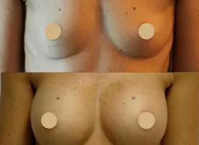 breast-before-after5