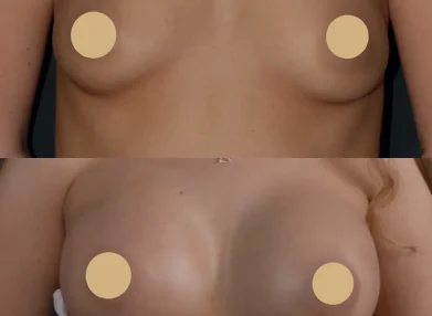 breast-before-after7
