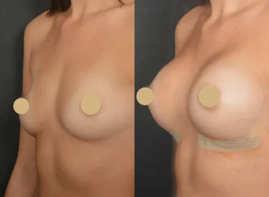 breast-before-after8