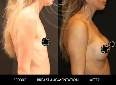 breast-surgery-cover1