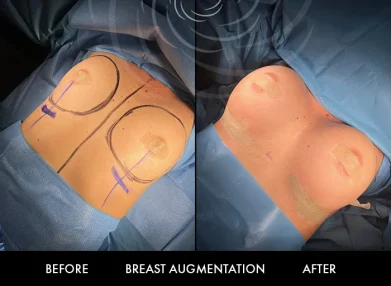 breast-surgery-cover2