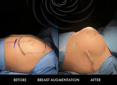 breast-surgery-cover3