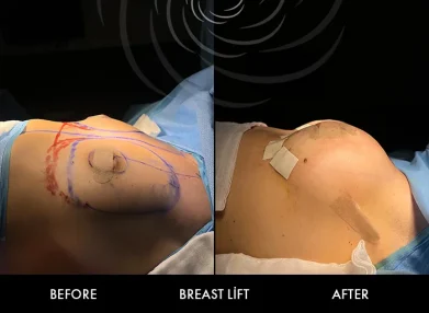 breast-surgery-cover4