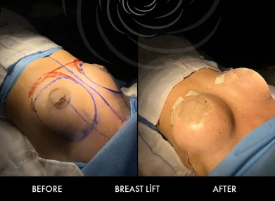 breast-surgery-cover5