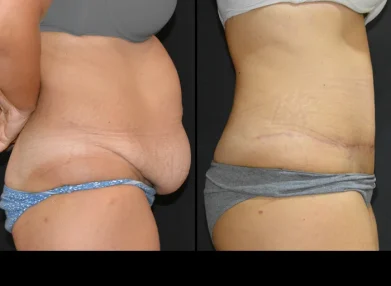 tummy-tuck-before-after0