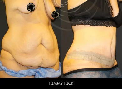 tummy-tuck-before-after11