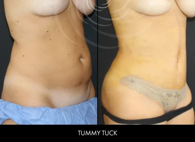 tummy-tuck-before-after12