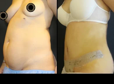tummy-tuck-before-after2