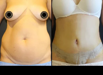 tummy-tuck-before-after3