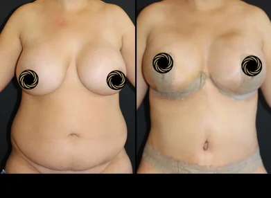 tummy-tuck-before-after4