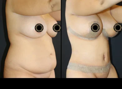 tummy-tuck-before-after5
