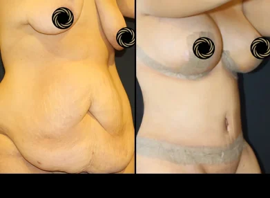 tummy-tuck-before-after6
