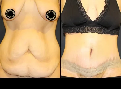 tummy-tuck-before-after7