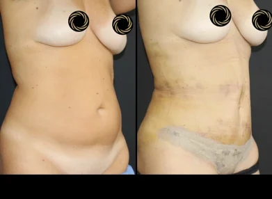 tummy-tuck-before-after8