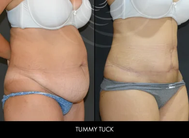 tummy-tuck-before-after9